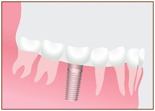 Différence entre les dents et un Implant dentaire
